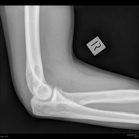 Radial Head Fracture – Core EM