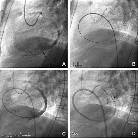 Effects of coronary sinus occlusion on myocardial ischaemia in humans: role of coronary ...