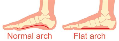 Fallen Arch Guide: Causes, Symptoms and Treatment Options