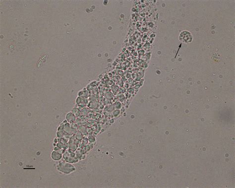 Urine casts | eClinpath