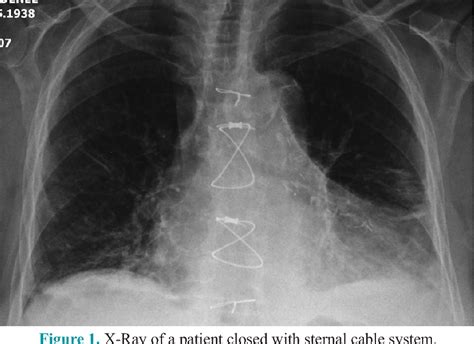 Figure 1 from Sternal cable wires for sternal closure in moderately or ...