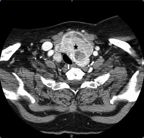 Dyspnea in multinodular goiter: a case report of substernal multinodular goiter complicated with ...