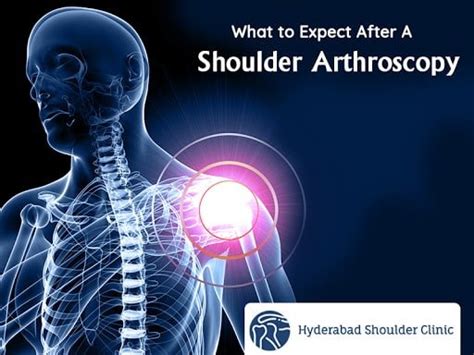 Overview: What to Expect After A Shoulder Arthroscopy For Rotator Cuff Repair - shoulder clinic ...