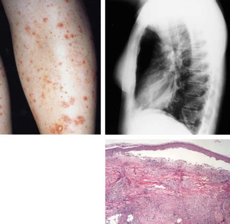 Klebsiella pneumoniae and leukocytoclastic vasculitis - The Lancet