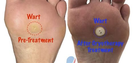 Podiatrist Treatment for Foot Warts or Plantar Verrucae