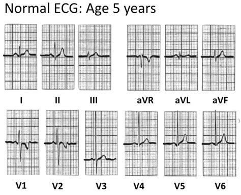 Normal paediatric ECG • LITFL • ECG Library Diagnosis