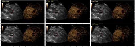 Volumetric Quantitative Contrast-enhanced Ultrasonography Evaluation of ...