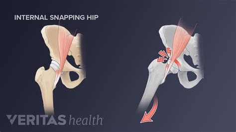 3 Types of Snapping Hip Syndrome - Bút Chì Xanh