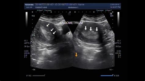 Ultrasound Video Showing Endometrial Hyperplasia Of Uterus Youtube | My ...