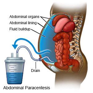 Paracentesis Procedure