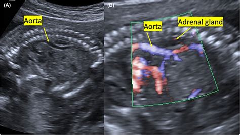 Sagittal view. (A) Deviation anterior to the abdominal aorta at T11-L1 ...