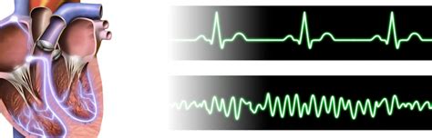 Ventricular Fibrillation Treatment and Causes | ACLS.com Resources