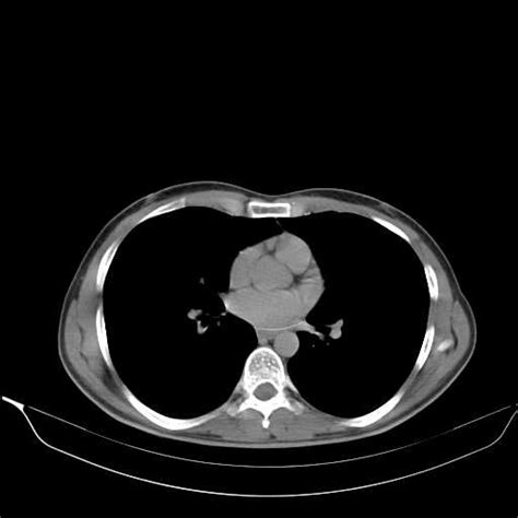 Chronic pancreatitis (Radiopaedia 21022-20949 Axial C+ delayed) - NC ...