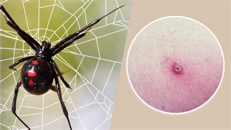 Black Widow Spider Bite Stages: Symptoms and Recovery