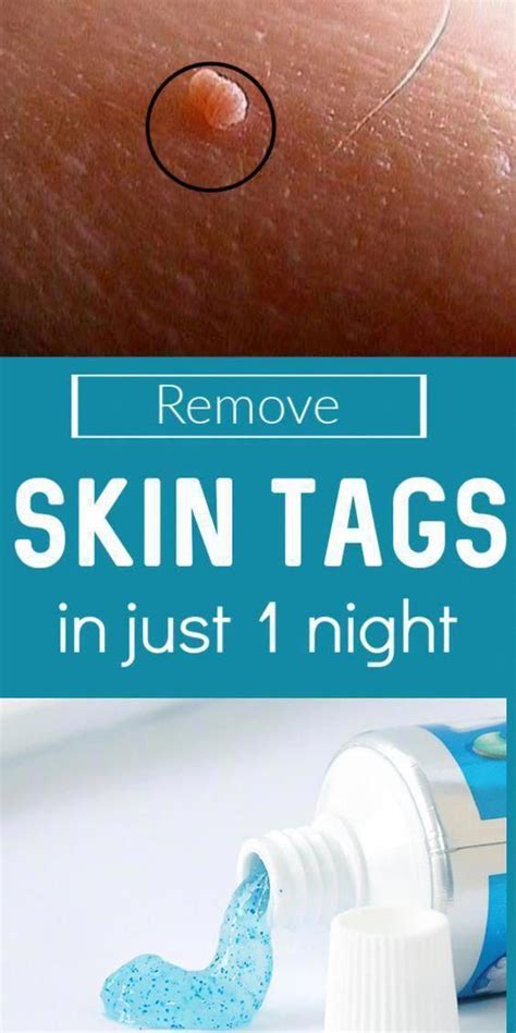 Get Rid Of Skin Tags Overnight Using These Natural remedies #TypesOfMolesOnSkin # ...