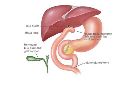 Right hepatectomy with ductoplasty and hepaticojejunostomy