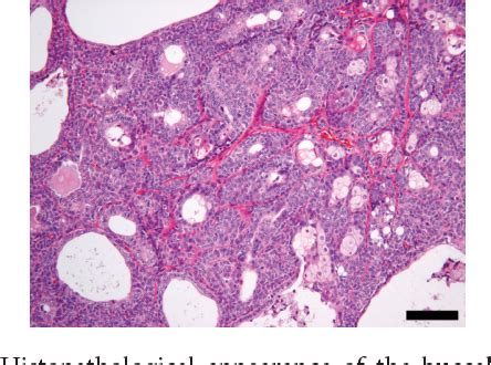 [PDF] Apocrine Sweat Gland Ductal Adenoma with Sebaceous ...