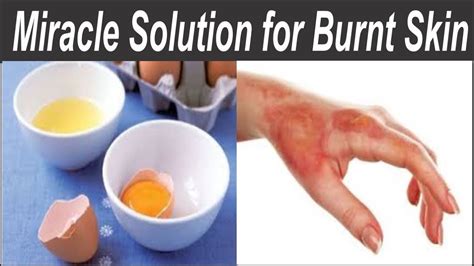 Best thing for grease burns, Home Remedies for Burns: What You Should Use