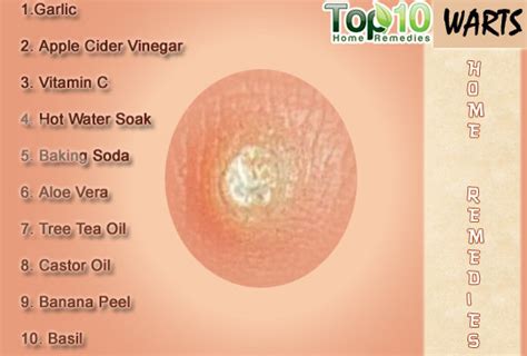 Home Remedies for Warts | Top 10 Home Remedies