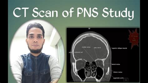 ct scan of pns coronal view filming text study - YouTube