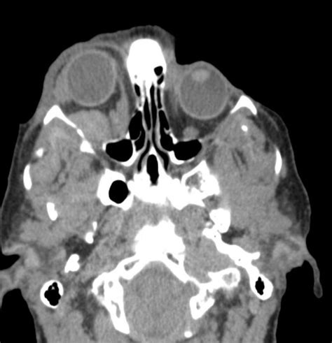 Blue rubber bleb nevus syndrome CT - wikidoc