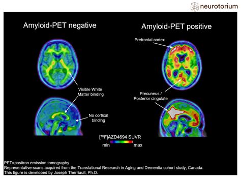 Amyloid-PET imaging in Alzheimer's disease - Neurotorium