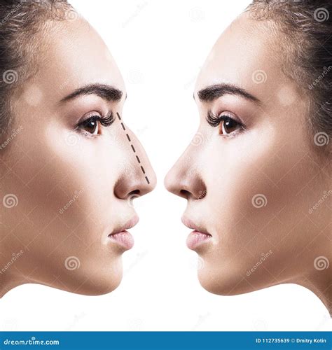 Female Nose before and after Cosmetic Surgery. Stock Image - Image of aesthetic, nose: 112735639