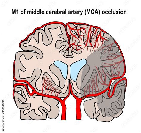 the illustration shown the proximal left M1 occlusion and large ...