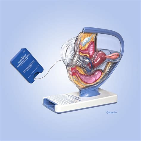 Nuvaring Placement Picture