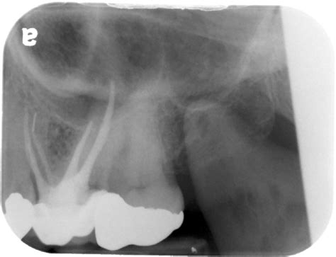 Anatomy Monday: Coronoid Process (mandible) – Dr. G's Toothpix