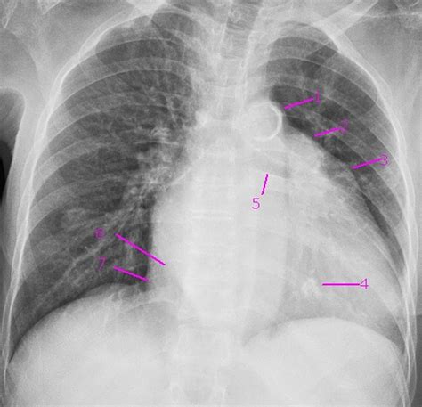 Cardiac chambers and pericardium on CXR – All About Cardiovascular ...