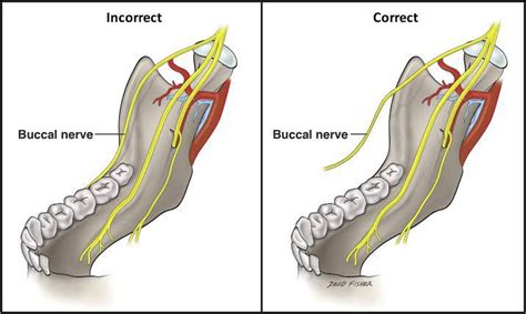 Long buccal nerve - MEDizzy