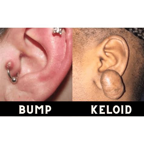 the differance between piercing Bumps and Keloids – Riri accessory