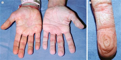 Aquagenic Wrinkling of the Palms in Patients With Cystic Fibrosis Homozygous for the ΔF508 CFTR ...