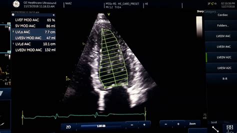 Ejection fraction measurement - YouTube