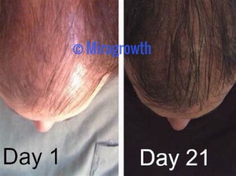 Mens Hair Growth Solution Oil Serum Hair Loss Products Receding ...