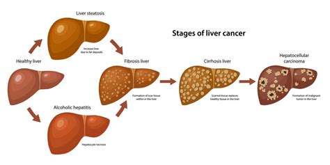 Stages of Liver Cancer | CyberKnife Treatment Center Miami