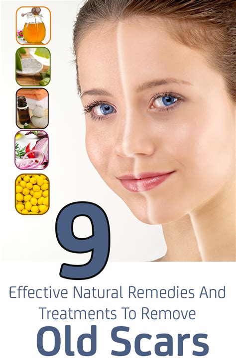 9 Effective Natural Remedies And Treatments To Remove Old Scars ...