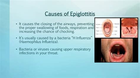 Acute epiglottitis by Joselyn