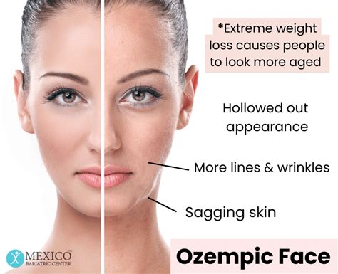 What Is Ozempic Face And How Can People Avoid It?, 56% OFF