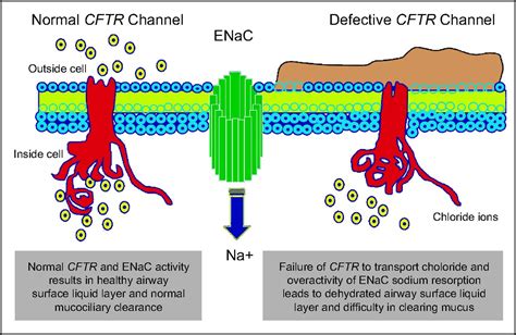 Cystic Fibrosis Lungs Mucus