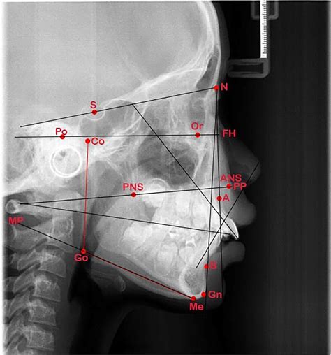 Landmarks of Cephalometric X-ray. Abbreviations of fig. 2: PNS:... | Download Scientific Diagram