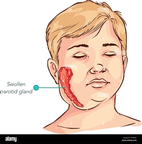 Parotid Gland Swelling Mumps