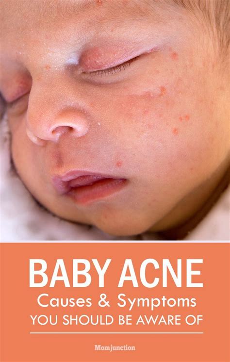 Baby Acne: What Causes Them And How You Can Prevent | Baby acne ...