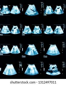 Echography Image Ultrasound Abdomen Stock Photo 1312497011 | Shutterstock