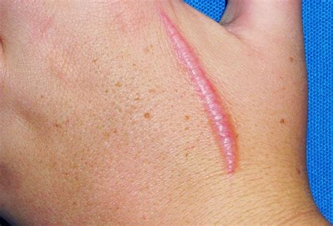 Pictures of Skin Diseases and Problems – Hypertrophic Scar