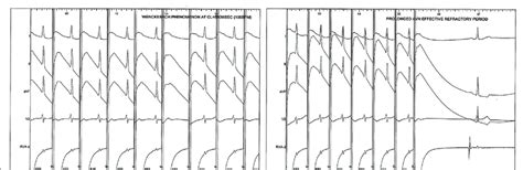 (a) Early Wenckebach phenomenon appearance during atrial pacing (cycle ...