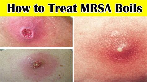 Top 6 Home Remedies for MRSA Boils || How to Treat MRSA Boils at Home - YouTube