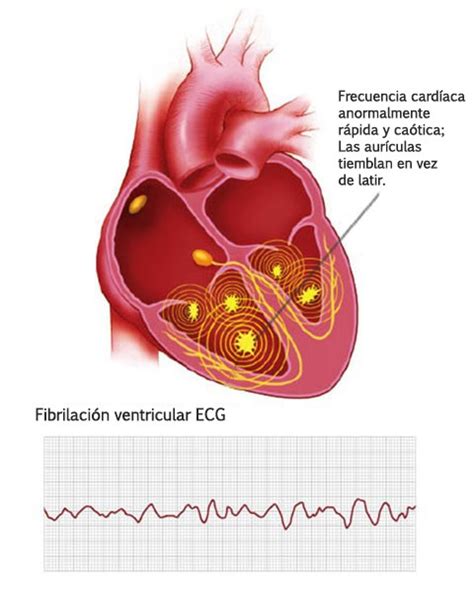 Arritmias Ventriculares | Boston Scientific