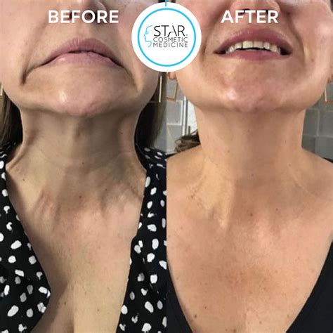 Neck Rejuvenation – Star Cosmetic Medicine